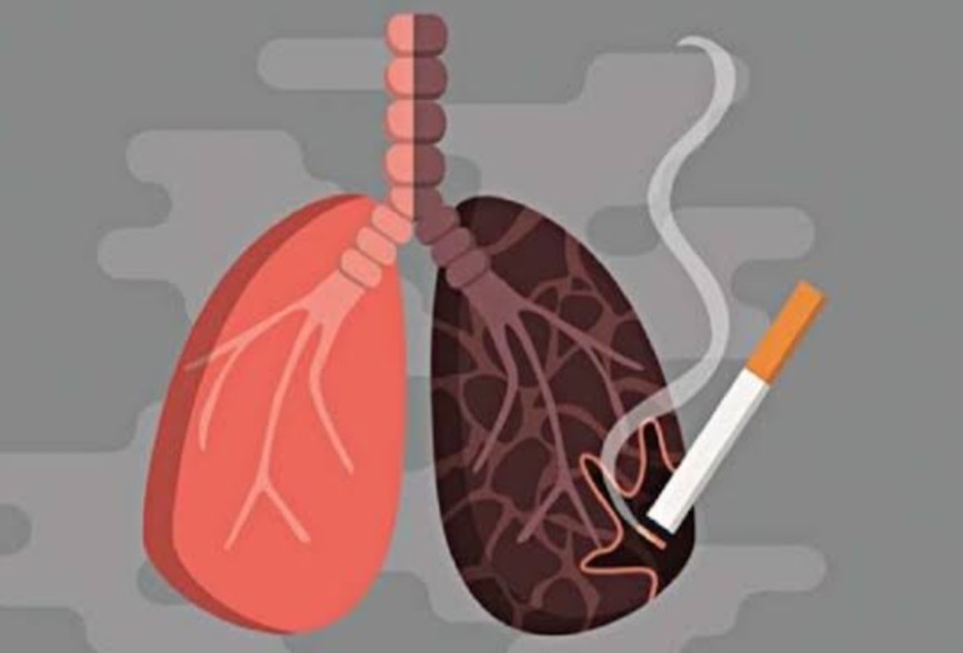 85 Persen Kanker Paru Terkait Kebiasaan Merokok