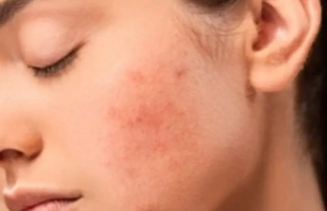 Kamu Mau Bebas Jerawat? Hindari Makanan Ini