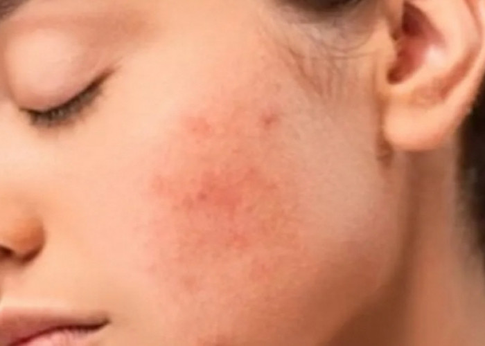 Kamu Mau Bebas Jerawat? Hindari Makanan Ini