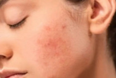 Kamu Mau Bebas Jerawat? Hindari Makanan Ini