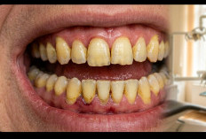 8 Cara Putihkan Gigi yang Kuning dengan Bahan Alami, Nomor 2 Gak Nyangka